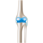 Cartilage Protection