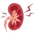 Eliminates Kidney stones